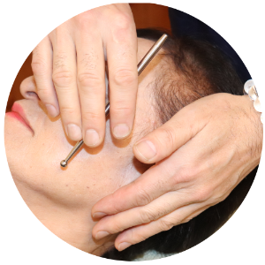 ソフトタッチ美容鍼
